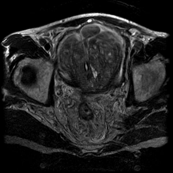 File:Benign prostatic hyperplasia (Radiopaedia 2586-6281 Axial T2 1).jpg