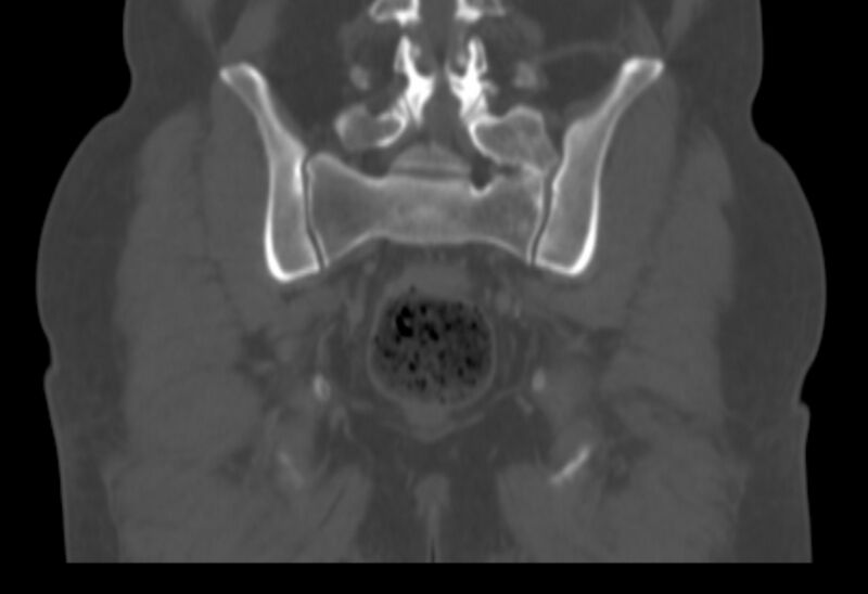 File:Bertolotti syndrome (Radiopaedia 58974-66235 Coronal bone window 12).jpg