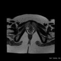 Bicornuate uterus- on MRI (Radiopaedia 49206-54297 Axial T2 16).jpg