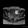 Bicornuate uterus- on MRI (Radiopaedia 49206-54297 Axial T2 9).jpg