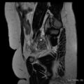 Bicornuate uterus- on MRI (Radiopaedia 49206-54297 Sagittal T2 23).jpg