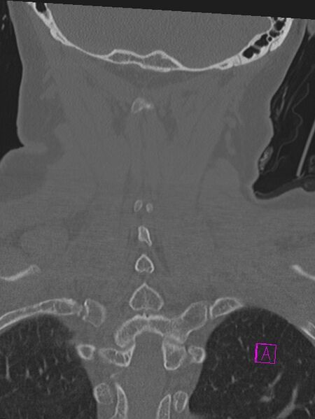File:Bilateral atlanto-occipital assimilation (Radiopaedia 28350-28603 Coronal bone window 39).jpg