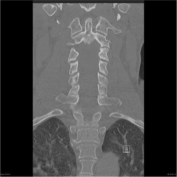 File:Bilateral cervical ribs (Radiopaedia 25868-26017 Coronal bone window 20).jpg