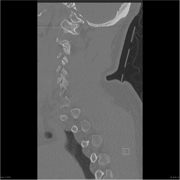 File:Bilateral cervical ribs (Radiopaedia 25868-26017 Sagittal bone window 17).jpg