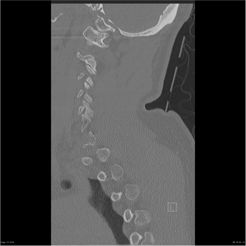 Bilateral cervical ribs (Radiopaedia 25868-26017 Sagittal bone window 17).jpg