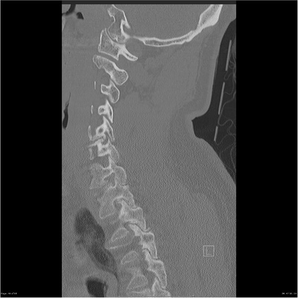 File:Bilateral cervical ribs (Radiopaedia 25868-26017 Sagittal bone window 46).jpg