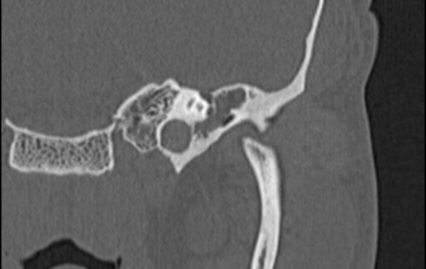 Bilateral cholesteatoma (Radiopaedia 54898-61172 D 3).jpg