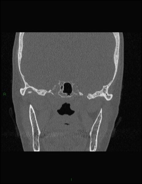 File:Bilateral frontal mucoceles (Radiopaedia 82352-96454 Coronal 256).jpg