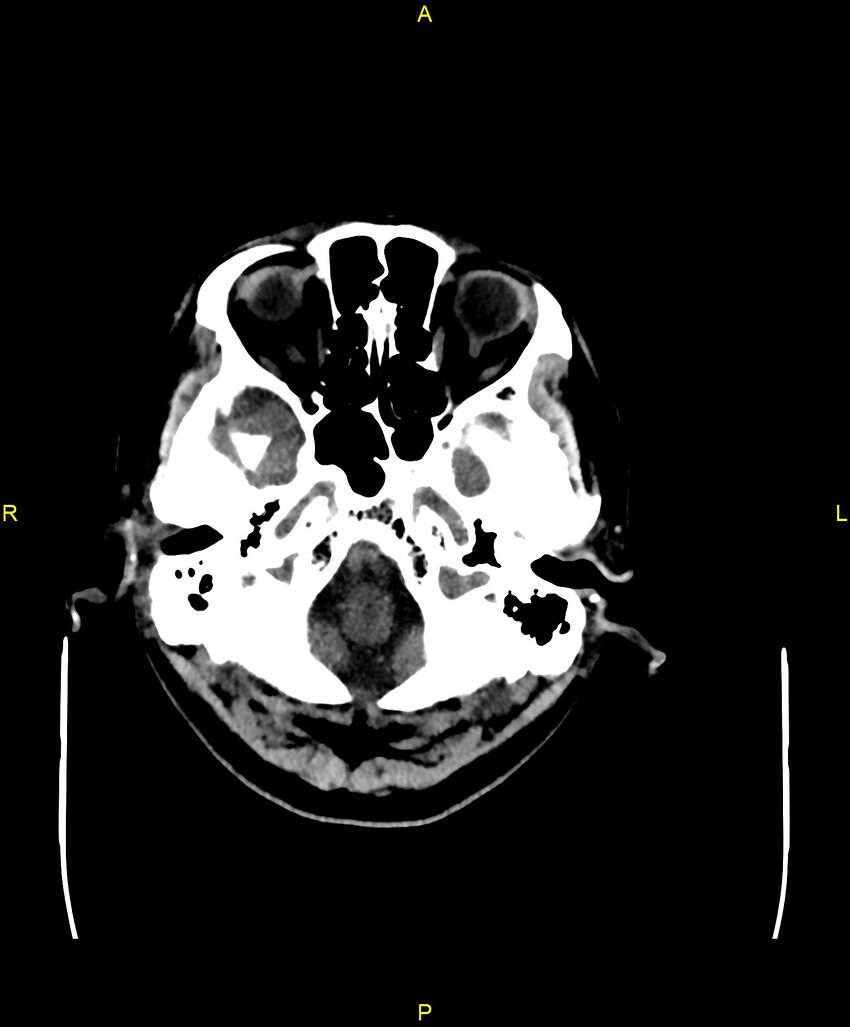 Bilateral isodense subdural hematomas (Radiopaedia 88621-105325 Axial non-contrast 14).jpg
