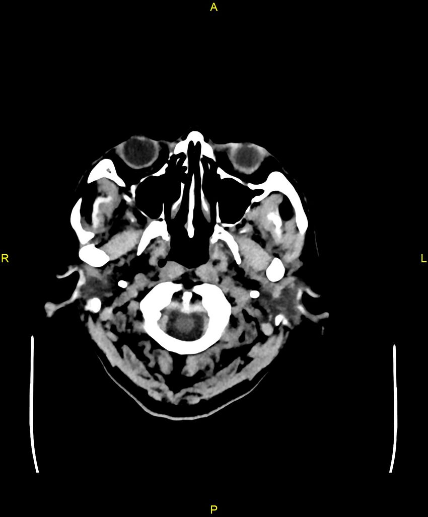 Bilateral isodense subdural hematomas (Radiopaedia 88621-105325 Axial non-contrast 2).jpg