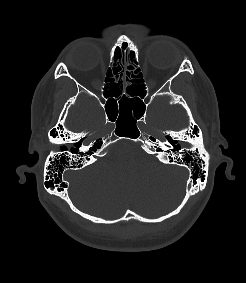 Bilateral medial canal fibrosis (Radiopaedia 85598-101344 Axial bone window 31).jpg