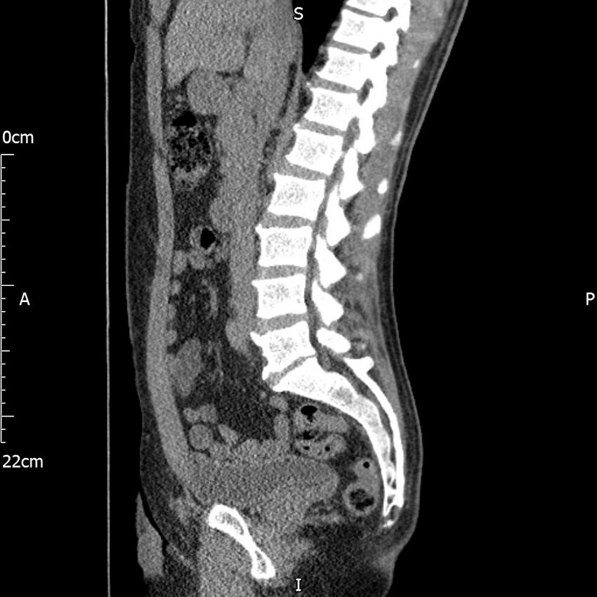 Bilateral medullary nephrocalcinosis with ureteric calculi (Radiopaedia 71269-81569 C 65).jpg