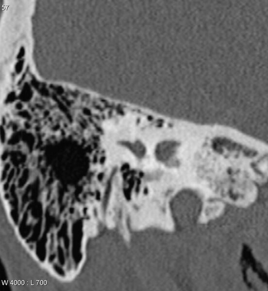 File:Bilateral otosclerosis with left stapes prosthesis (Radiopaedia 5567-7302 Coronal bone window 14).jpg