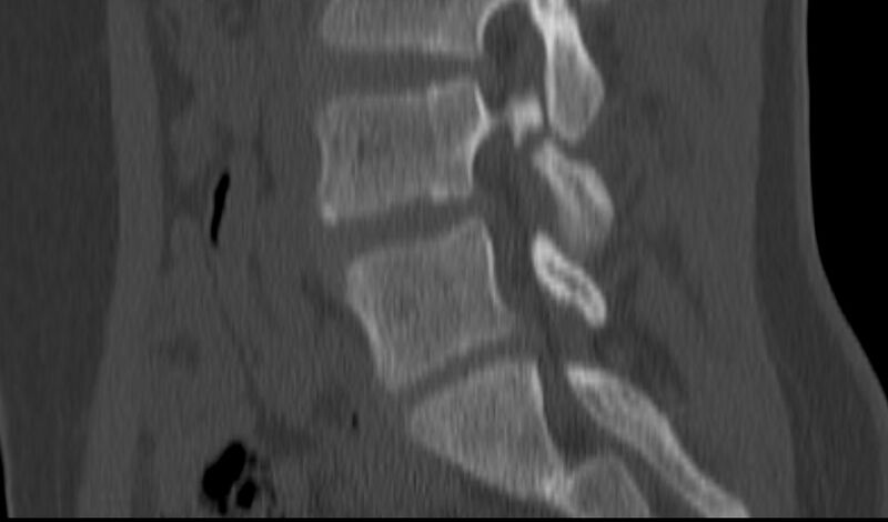 File:Bilateral pars defect (Radiopaedia 26691-26846 Sagittal bone window 26).jpg