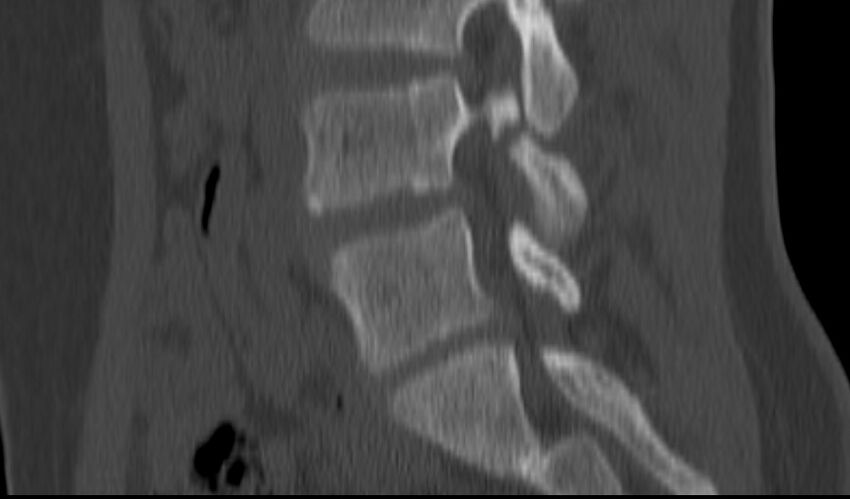 Bilateral pars defect (Radiopaedia 26691-26846 Sagittal bone window 26).jpg