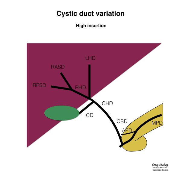 File:Biliary duct anatomic variation (diagram) (Radiopaedia 70380-80479 Cystic duct 4).jpeg