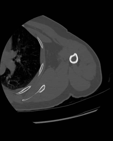 File:Bizarre parosteal osteochondromatous proliferation (Radiopaedia 84221-99501 Axial bone window 34).jpg