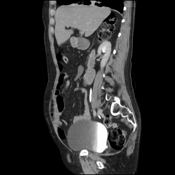 File:Bladder tumor detected on trauma CT (Radiopaedia 51809-57609 E 47).jpg