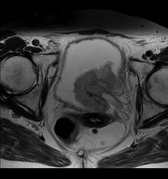 File:Bladder tumor detected on trauma CT (Radiopaedia 51809-57639 Axial T2 9).jpg