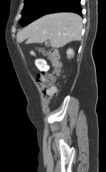 File:Bleeding duodenal ulcer and adenomyomatosis of gallbladder (Radiopaedia 61834-69861 C 18).jpg