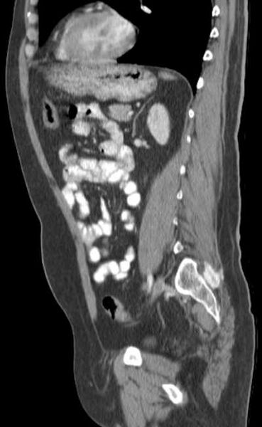File:Bleeding duodenal ulcer and adenomyomatosis of gallbladder (Radiopaedia 61834-69861 C 65).jpg