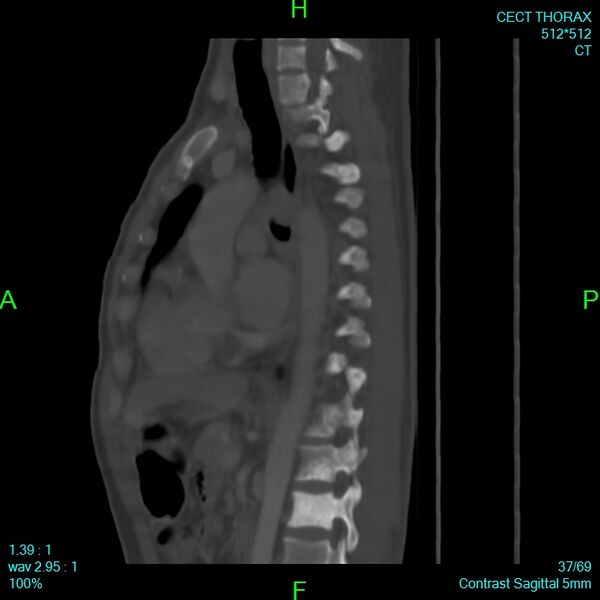 File:Bone metastases from lung carcinoma (Radiopaedia 54703-60937 Sagittal bone window 37).jpg