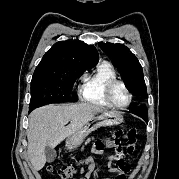 File:Brain metastases - lung cancer primary (Radiopaedia 75060-86116 C+ arterial phase 13).jpg