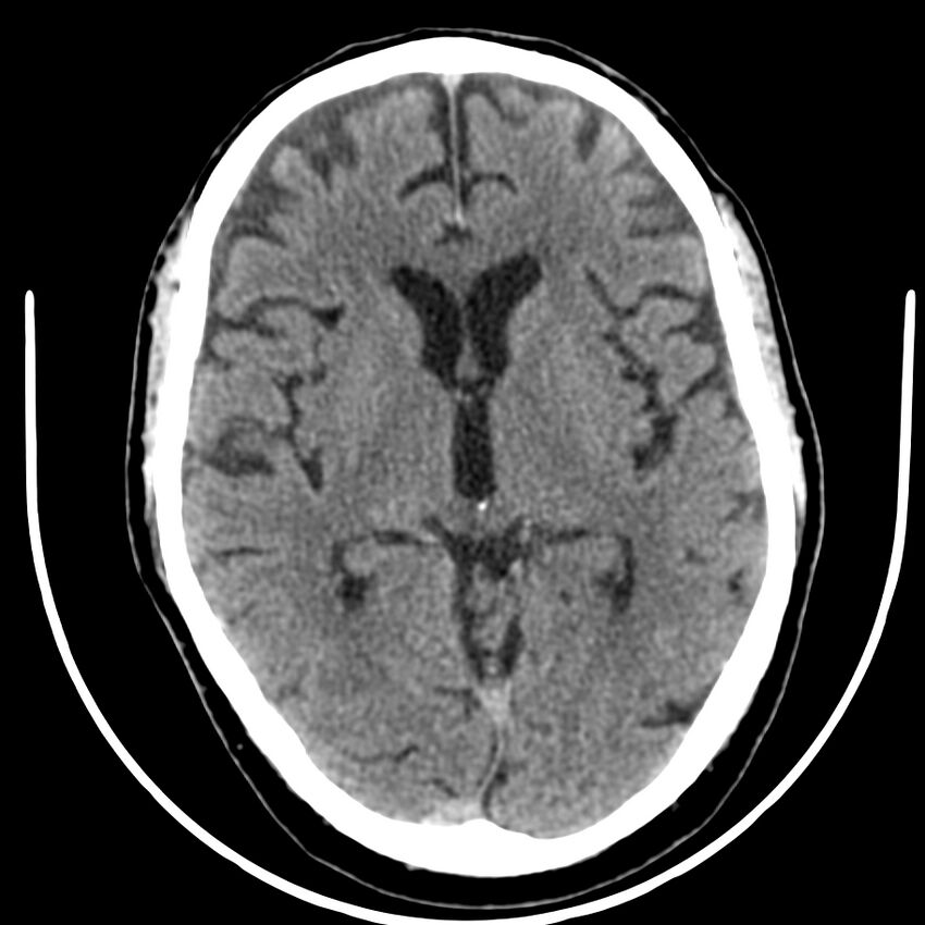 Brain metastasis (Radiopaedia 42617-45760 Axial non-contrast 22).jpg