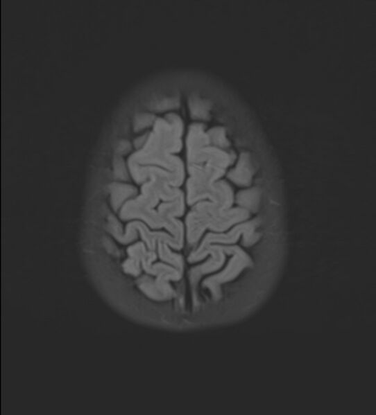 File:Brainstem glioma (Radiopaedia 70548-80674 Axial FLAIR 22).jpg