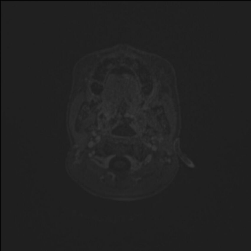 Brainstem glioma (Radiopaedia 70548-80674 Axial T1 C+ 3).jpg