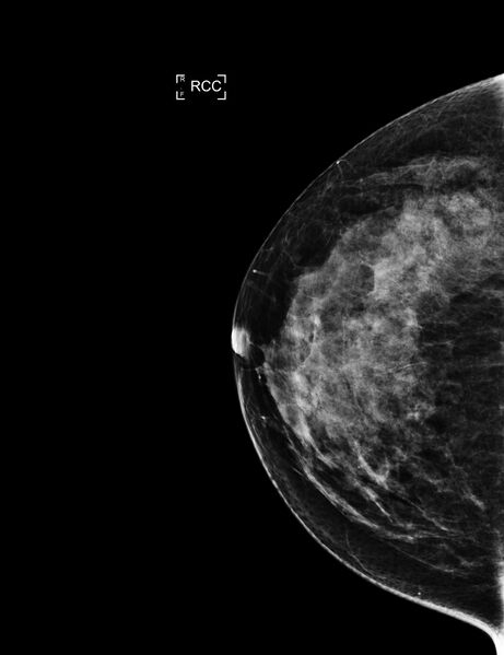 File:Breast hamartoma (Radiopaedia 65421-74481 CC 1).jpg