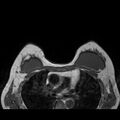 Breast implants - MRI (Radiopaedia 26864-27035 Axial T1 36).jpg