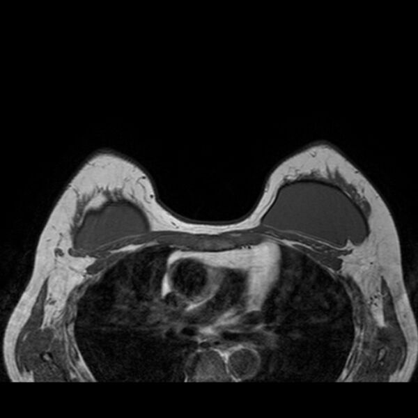 File:Breast implants - MRI (Radiopaedia 26864-27035 Axial T1 36).jpg