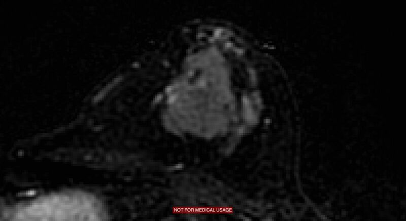 File:Breast lymphoma (MRI) (Radiopaedia 34999-36498 C 3).jpg