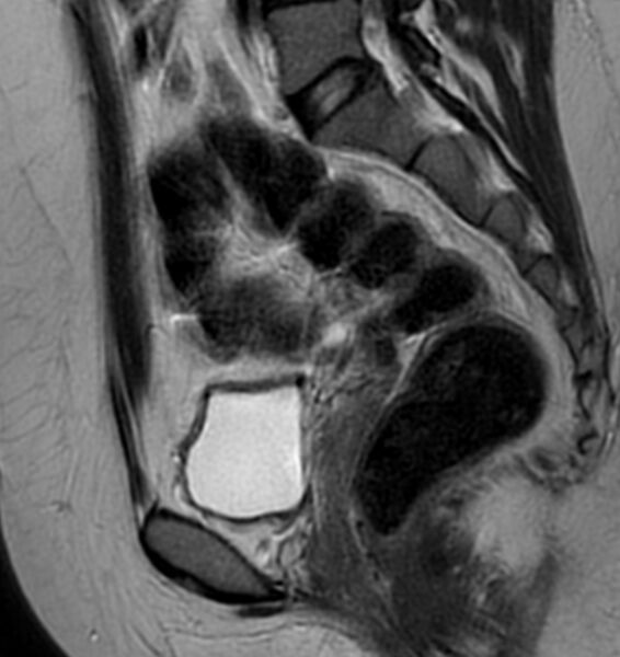 File:Broad ligament leiomyoma (Radiopaedia 81634-95516 Sagittal T2 13).jpg