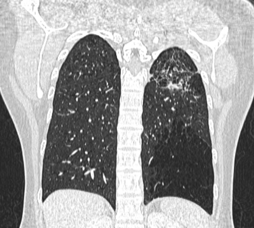 Bronchial atresia (Radiopaedia 50007-55297 Coronal lung window 90).jpg