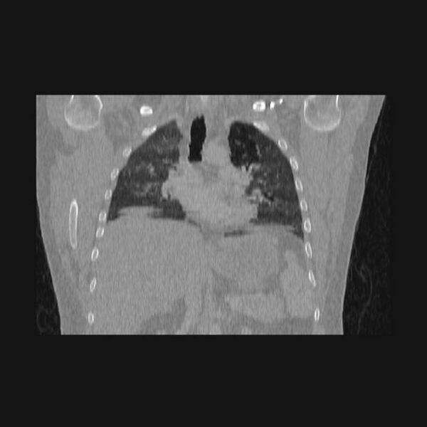 File:Bronchial atresia (Radiopaedia 60685-68439 Coronal lung window 37).jpg