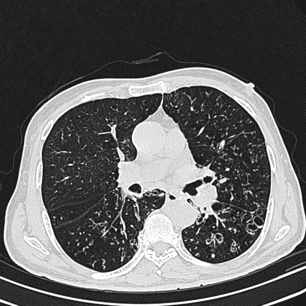 File:Bronchiectasis (Radiopaedia 22061-22059 lung window 15).jpg