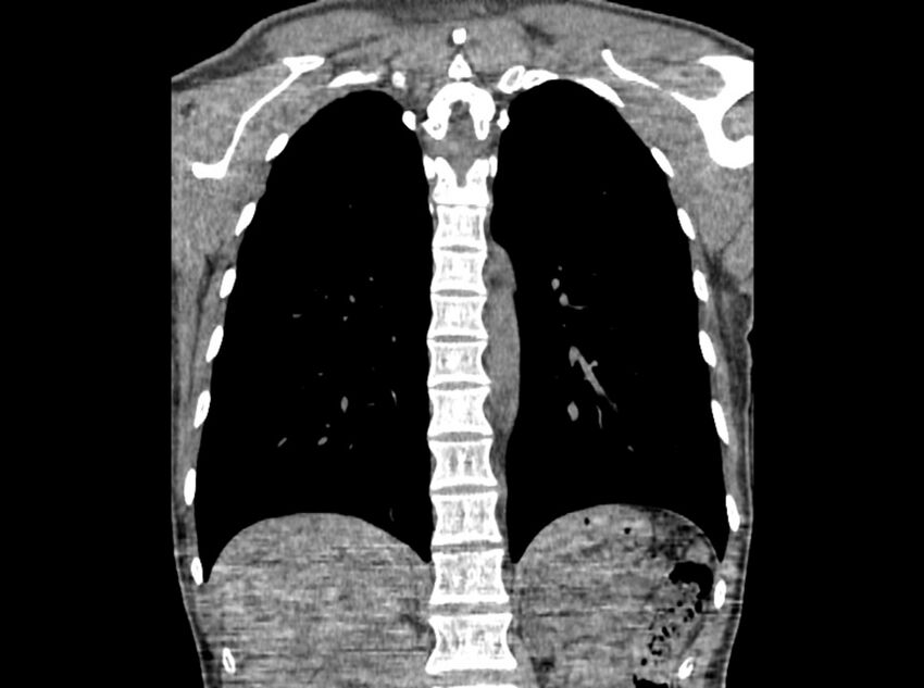 Bronchogenic cyst (Radiopaedia 80273-93615 D 75).jpg