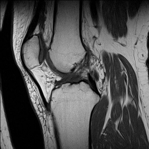 File:Bucket handle tear - medial meniscus (Radiopaedia 79028-91942 Sagittal T1 12).jpg