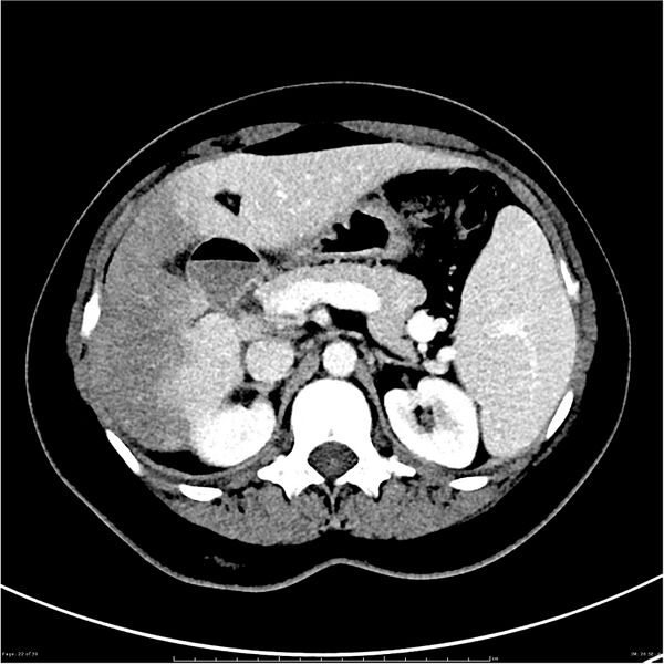 File:Budd-Chiari syndrome (Radiopaedia 27929-28177 Axial liver window 22).JPG