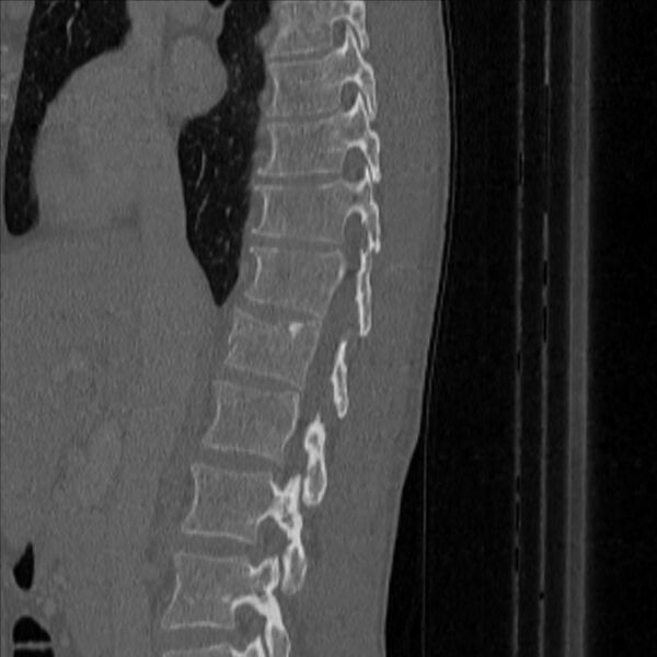 File:Bulging of paraspinal line in traumatic thoracal spinal compression fracture (Radiopaedia 29221-35872 Sagittal bone window 15).jpg