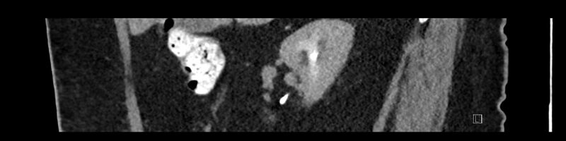 File:Buried bumper syndrome - gastrostomy tube (Radiopaedia 63843-72575 Sagittal Inject 84).jpg