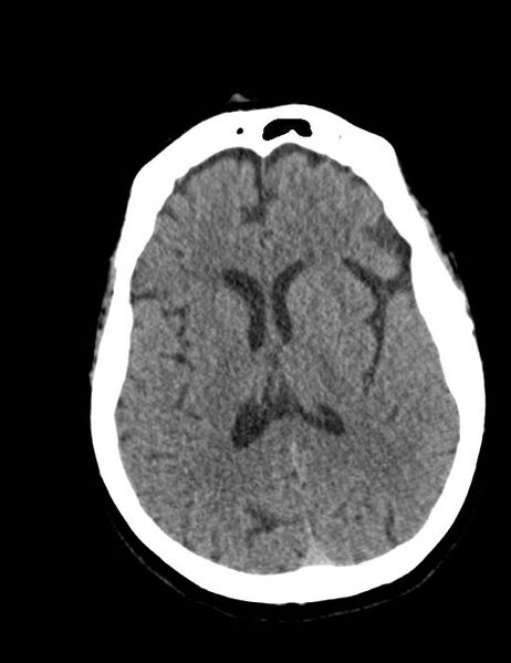 File:Burnt-out meningioma (Radiopaedia 51557-57337 Axial non-contrast 25).jpg