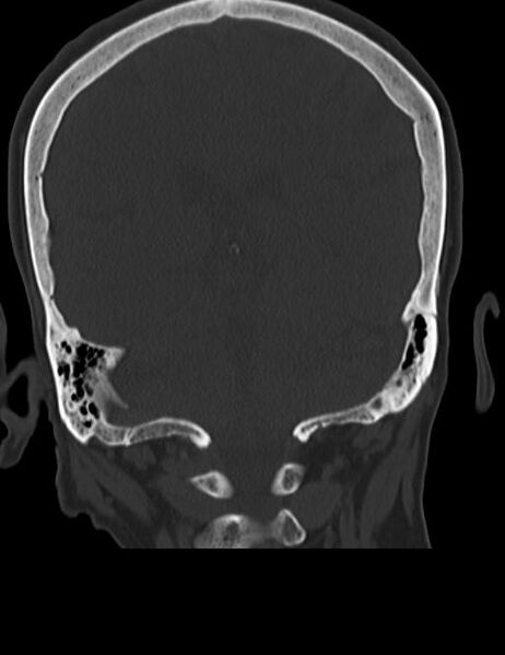 File:Burnt-out meningioma (Radiopaedia 51557-57337 Coronal bone window 36).jpg