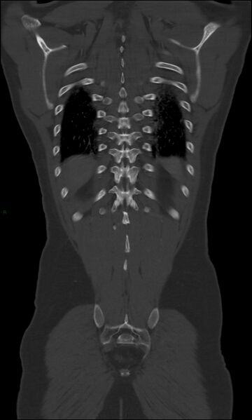 File:Burst fracture (Radiopaedia 83168-97542 Coronal bone window 61).jpg