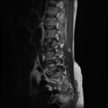Burst fracture - lumbar spine (Radiopaedia 72877-83541 Sagittal T2 2).jpg