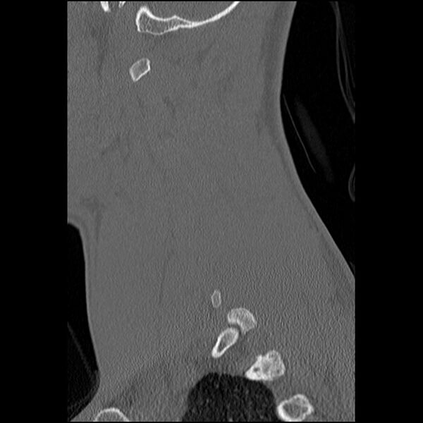 File:C5 facet fracture (Radiopaedia 58374-65499 Sagittal bone window 54).jpg