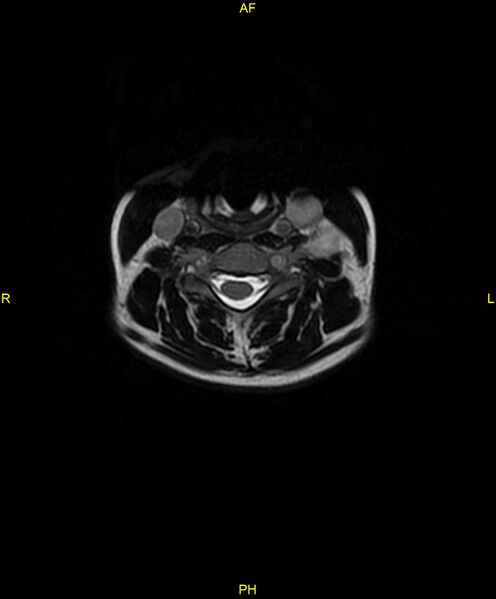 File:C5 nerve sheath tumor (Radiopaedia 85777-101596 Axial T2 31).jpg