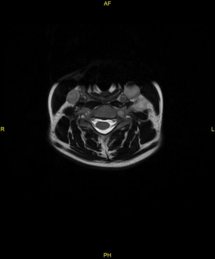 C5 nerve sheath tumor (Radiopaedia 85777-101596 Axial T2 31).jpg